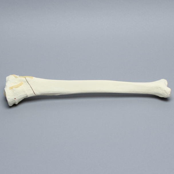 Tibia with Bicondylar and Oblique Fractures