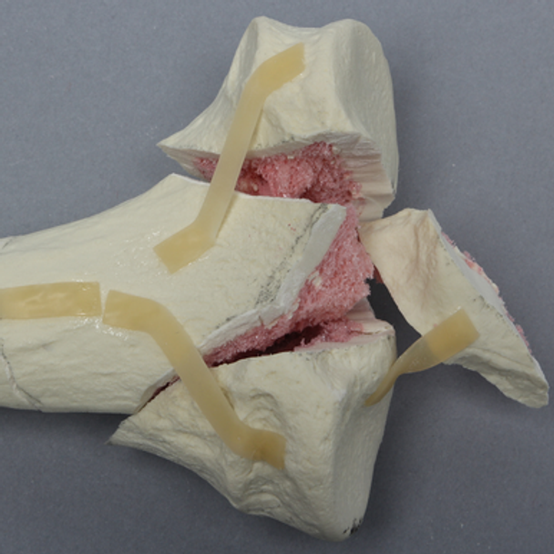 Tibia with Bicondylar and Oblique Fractures