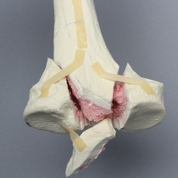 Tibia with Bicondylar and Oblique Fractures