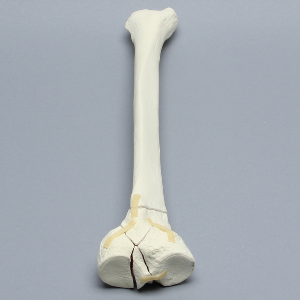 Tibia with Bicondylar and Oblique Fractures