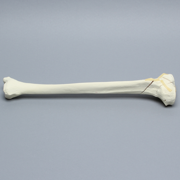 Tibia with Bicondylar and Oblique Fractures