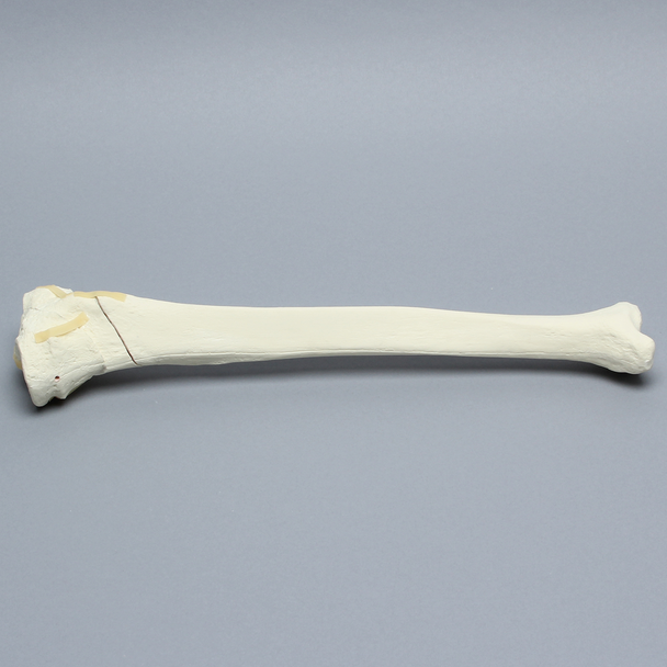 Tibia with Bicondylar and Oblique Fractures
