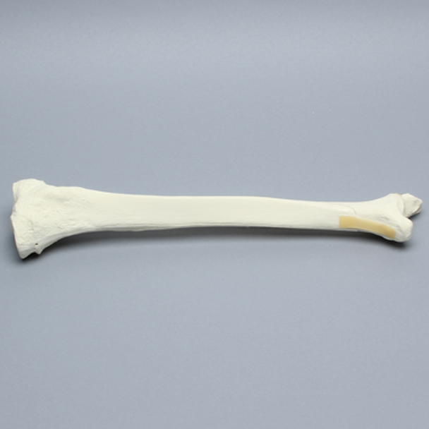 Tibia and Fibula with Spiral Fracture