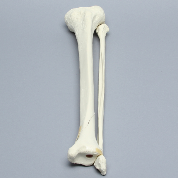 Tibia and Fibula with Spiral Fracture
