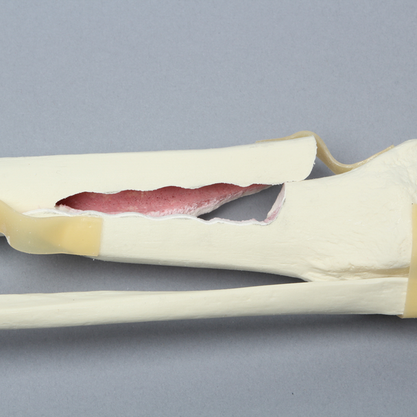 Tibia and Fibula with Spiral Fracture