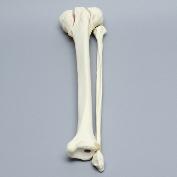 Tibia and Fibula with Bicondylar Fracture