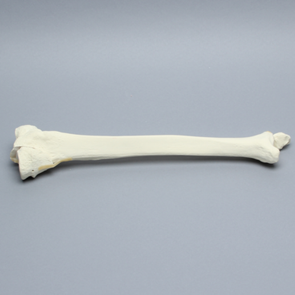 Tibia and Fibula with Bicondylar Fracture