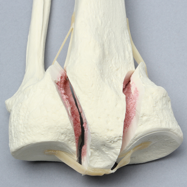Tibia and Fibula with Bicondylar Fracture