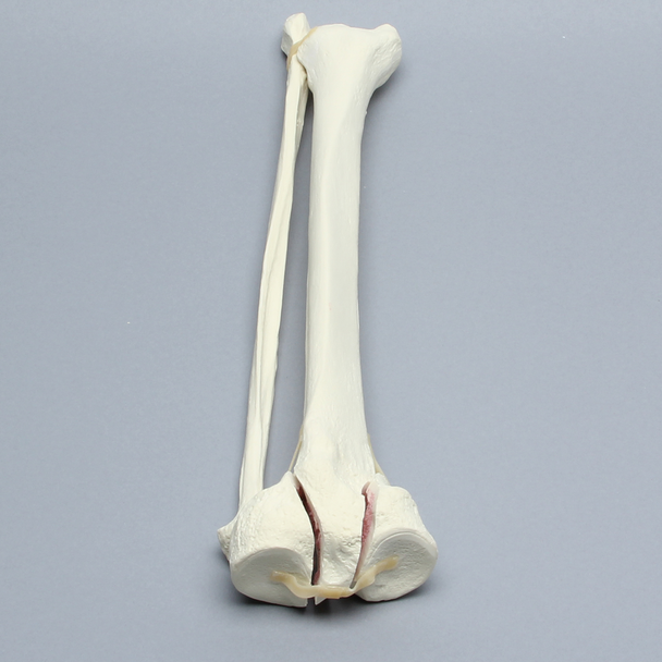 Tibia and Fibula with Bicondylar Fracture