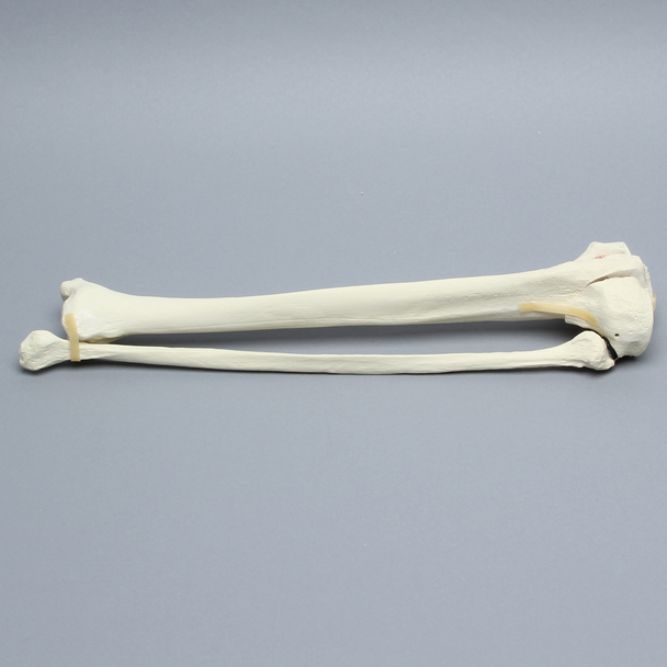 Tibia and Fibula with Bicondylar Fracture