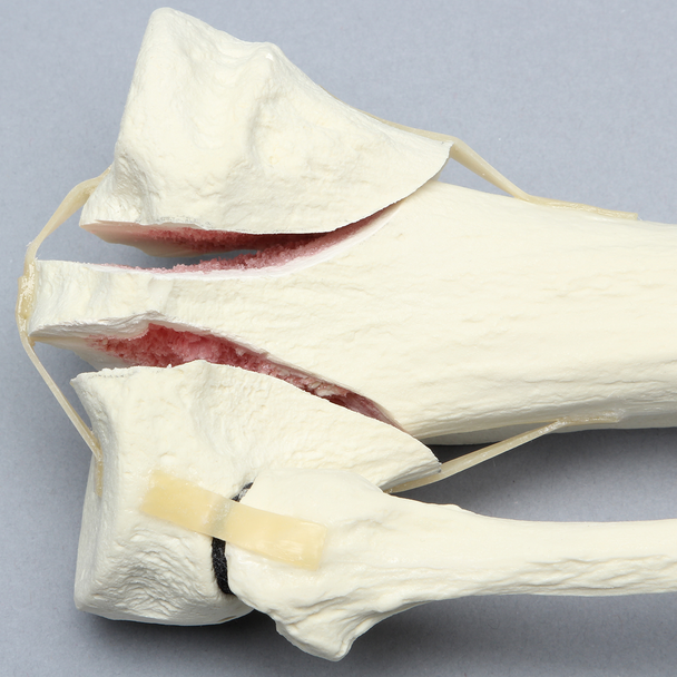Tibia and Fibula with Bicondylar Fracture