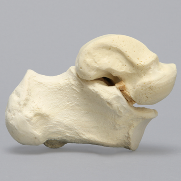 Talus and Calcaneus, Talocalcaneal Joint, Solid Foam