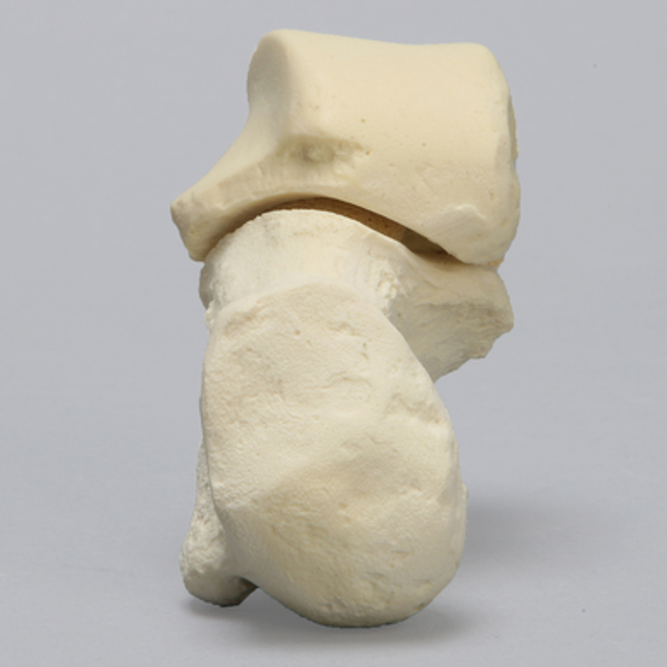 Talus and Calcaneus, Talocalcaneal Joint, Solid Foam