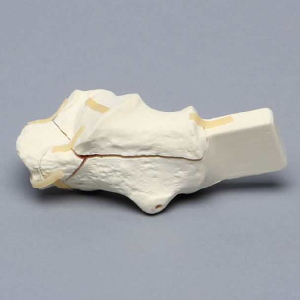 Calcaneus with Five-Part Fracture, Foam Cortical, Left