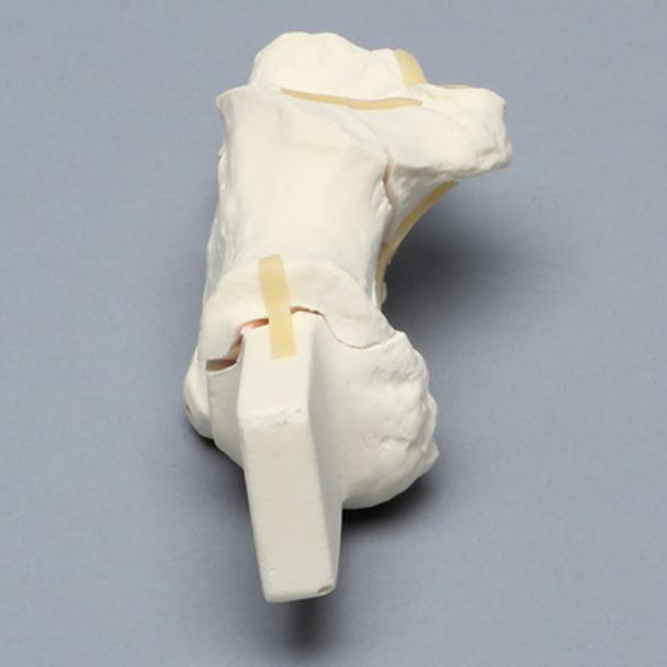 Calcaneus with Five-Part Fracture, Foam Cortical, Left