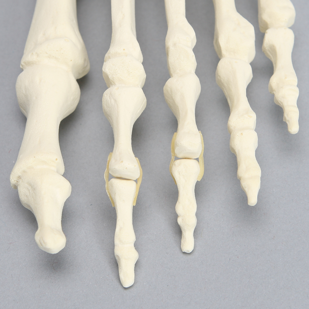 Forefoot with Hammertoe, Foam Cortical, Left, Large