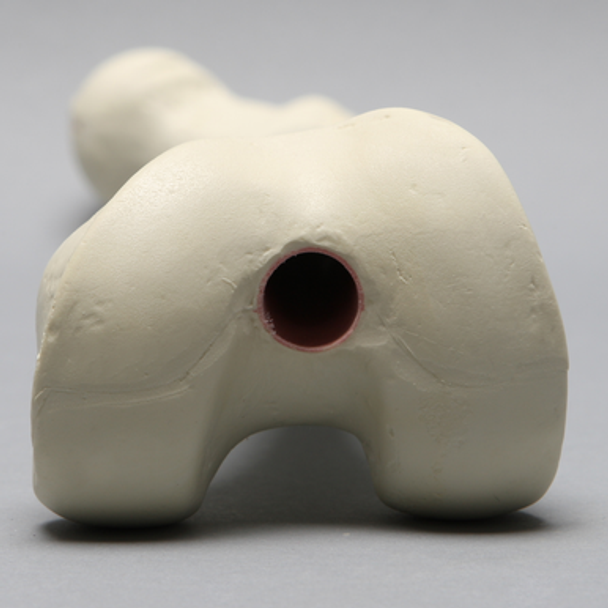 Femur, 14 mm, Trochanteric Entry Site, Foam Cortical