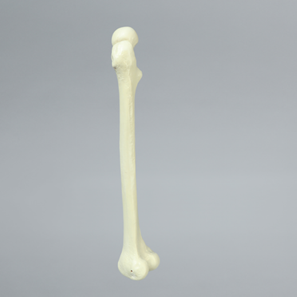 Femur with Neck Deformity, Pediatric