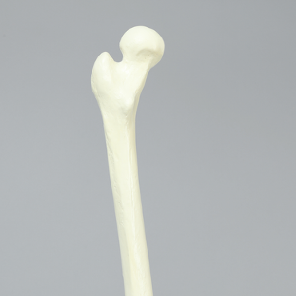 Femur with Neck Deformity, Pediatric