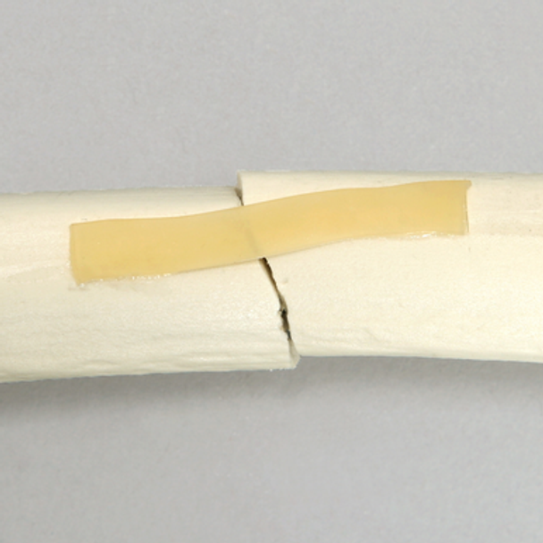 Femur with Light Density Cancellous and Fracture