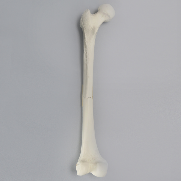 Femur with Light Density Cancellous and Fracture