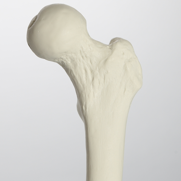 Femur with Light Density Cancellous