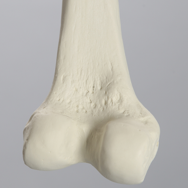 Femur with Light Density Cancellous