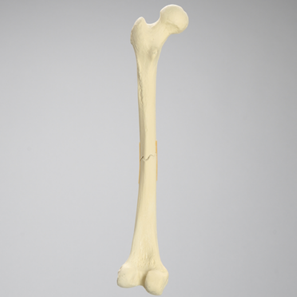 Femur with Transverse Fracture, Foam Cortical, Left, Small