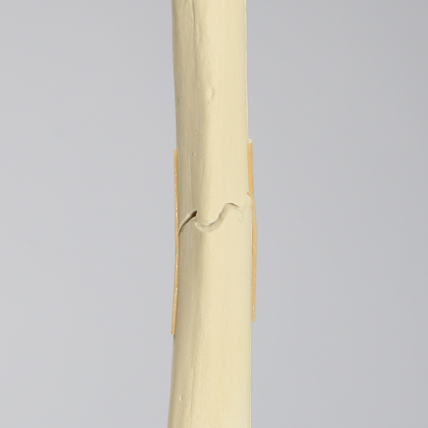 Femur with Transverse Fracture, Foam Cortical, Left, Small