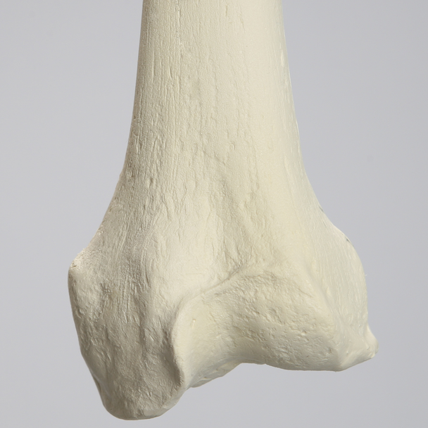 Femur with Arthritis, Foam Cortical, Left, Medium
