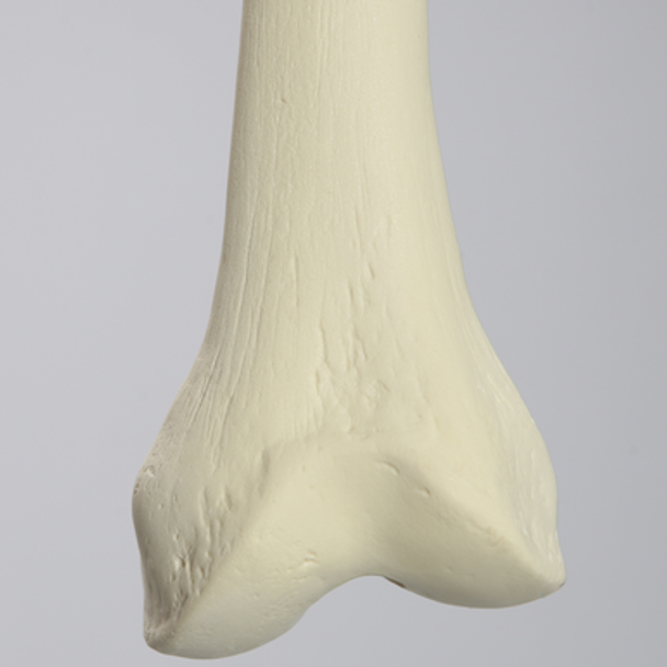 Femur, 10 Degree Distal Valgus Deformity, Foam Cortical, Left