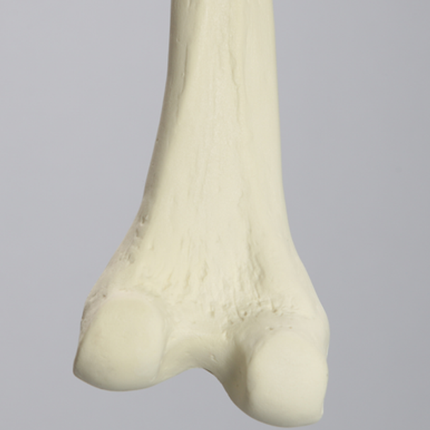 Femur, 10 Degree Distal Valgus Deformity, Foam Cortical, Left