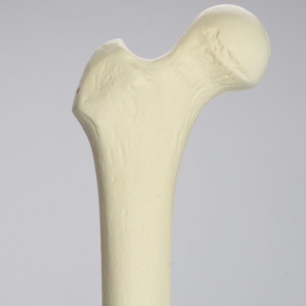 Femur, 15 mm Canal, Foam Cortical, Right, Medium