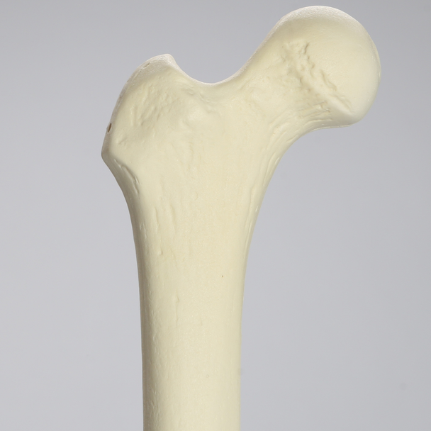 Femur, 15 mm Canal, Foam Cortical, Right, Medium