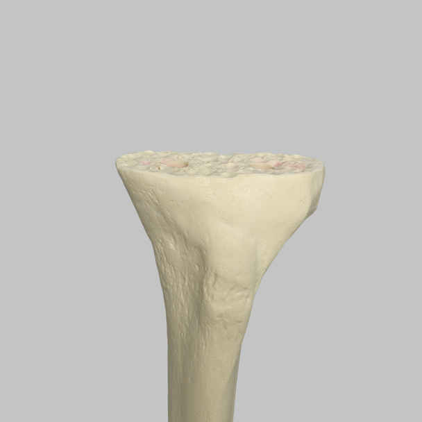 Tibia Proximal Resection, Foam Cortical, Left, Medium