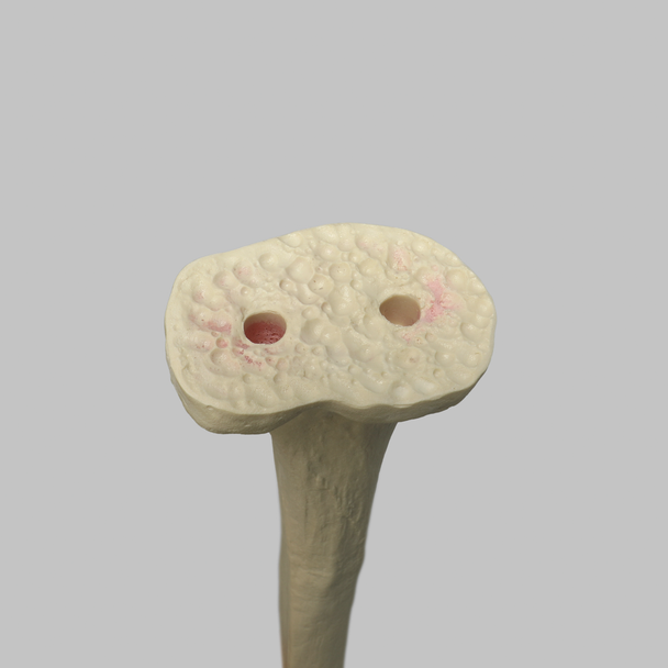 Tibia Proximal Resection, Foam Cortical, Left, Medium