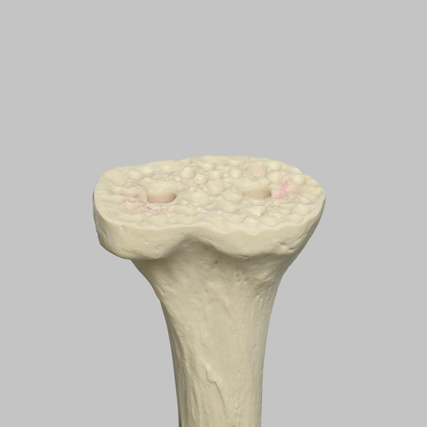 Tibia Proximal Resection, Foam Cortical, Left, Medium