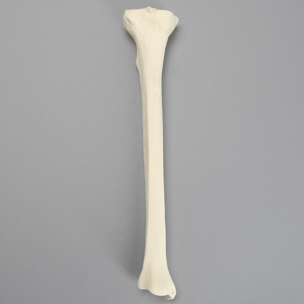 Tibia with Arthritis, Left
