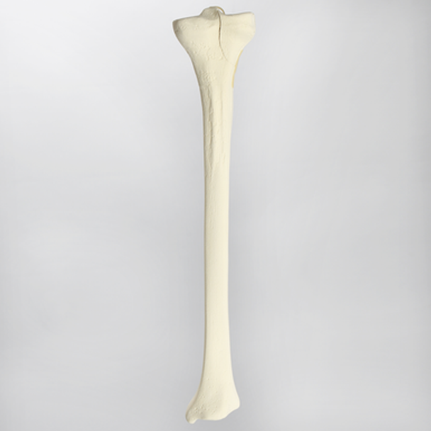 Tibia with Condylar Fracture and Fragment, Right, Medium