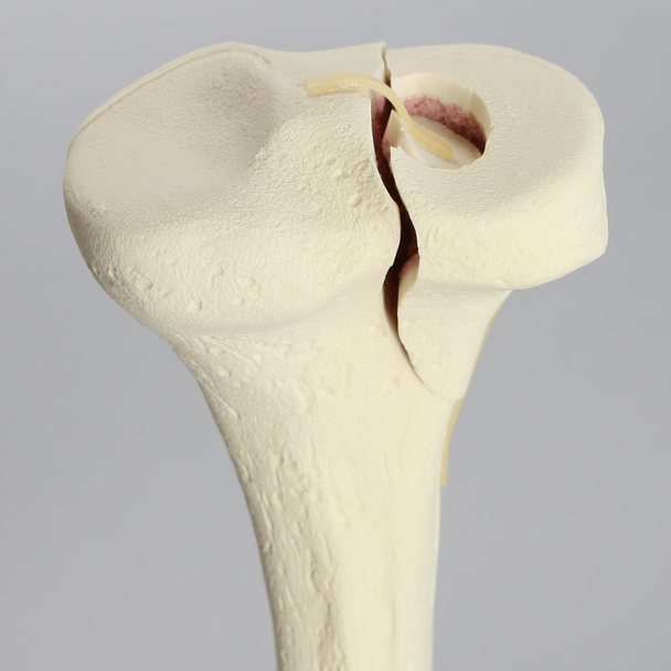 Tibia with Condylar Fracture and Fragment, Right, Medium