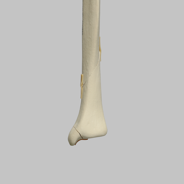 Tibia with Plateau, Spiral, and Malleolar Fractures, Left