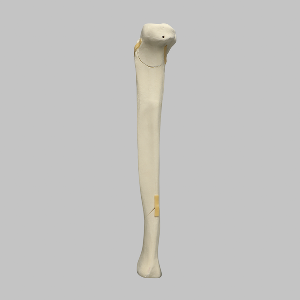 Tibia with Plateau, Spiral, and Malleolar Fractures, Left