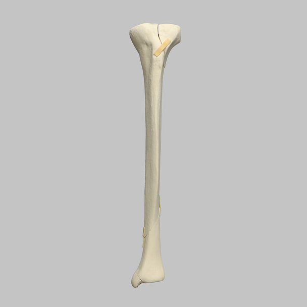 Tibia with Plateau, Spiral, and Malleolar Fractures, Left