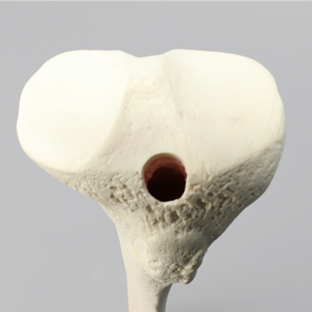 Tibia with 12 mm Canal, Oblique Fracture for IM Nail