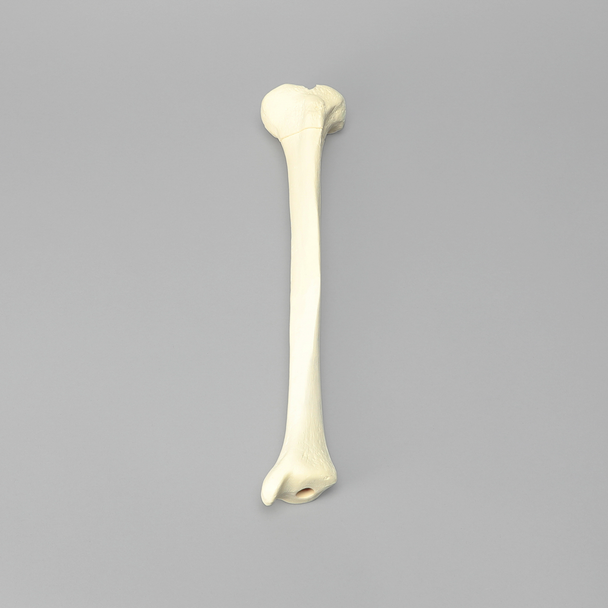 Tibia with 12 mm Canal, Oblique Fracture for IM Nail