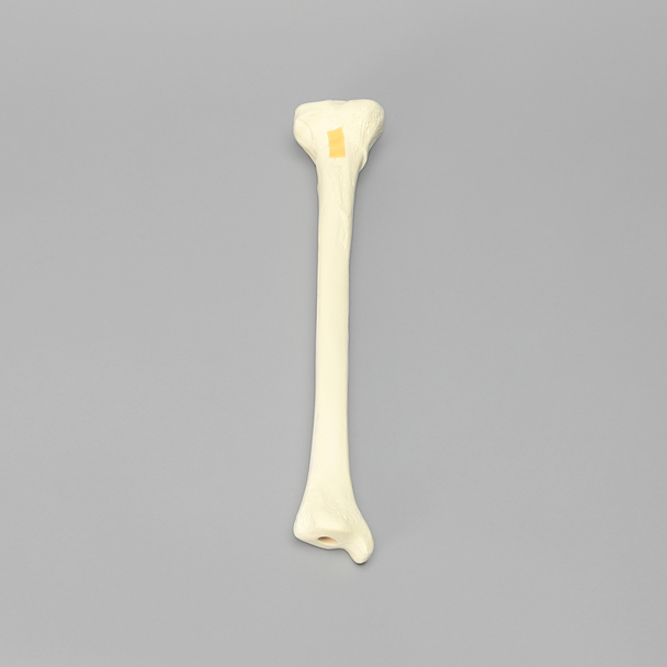 Tibia with 12 mm Canal, Oblique Fracture for IM Nail