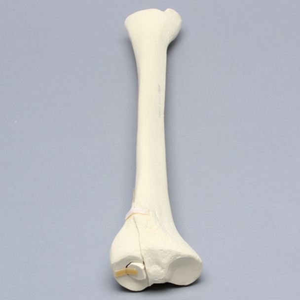 Tibia with Displaced Condylar Fracture and Fragment