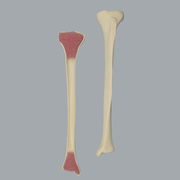 Tibia with Osteoporotic Cortex, Right, Medium