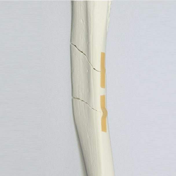 Tibia with Segmental Fracture, Solid Foam, Left, Medium