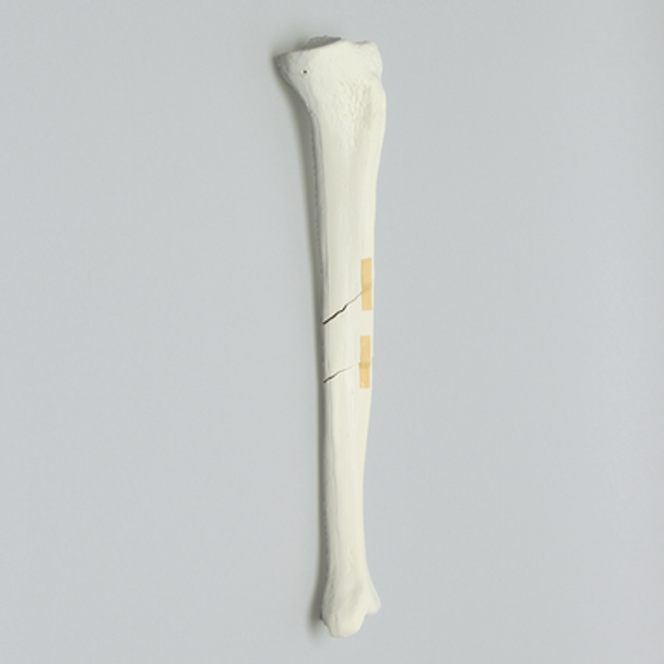 Tibia with Segmental Fracture, Solid Foam, Left, Medium